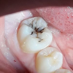 Лечение зубов в Усть-Каменогорске