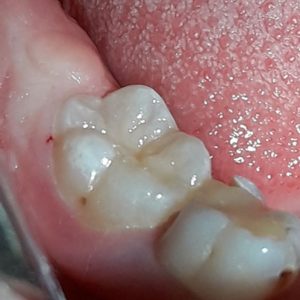 Лечение зубов в Усть-Каменогорске