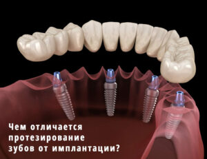 Чем отличается протезирование зубов от имплантации?