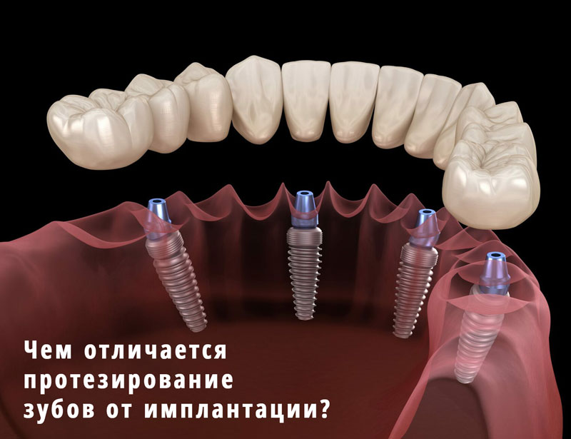 Чем отличается протезирование зубов от имплантации?