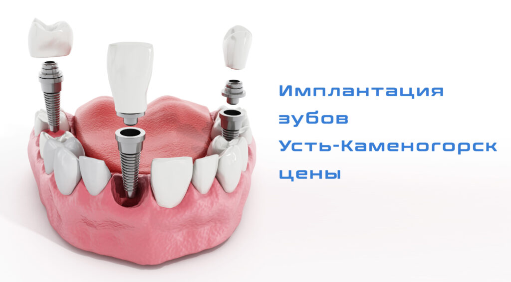 имплантация зубов Усть-Каменогорск цены