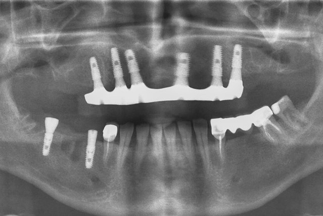 Поставить зубной имплант в Усть-Каменогорске. Стоматология на стрелке Аль-Дента.