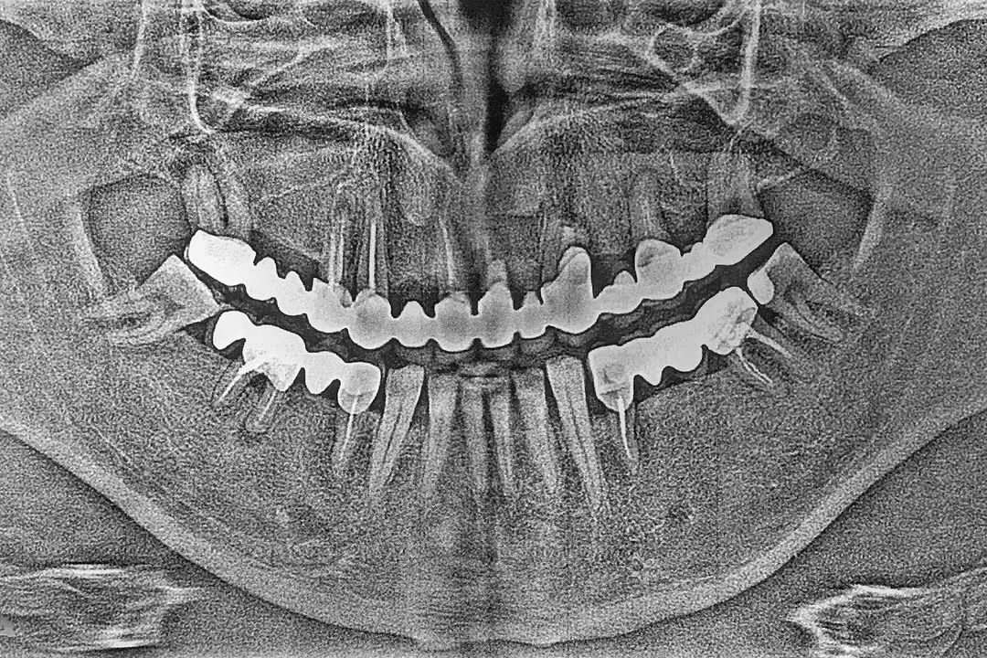 Поставить зубной имплант в Усть-Каменогорске. Стоматология на стрелке Аль-Дента.