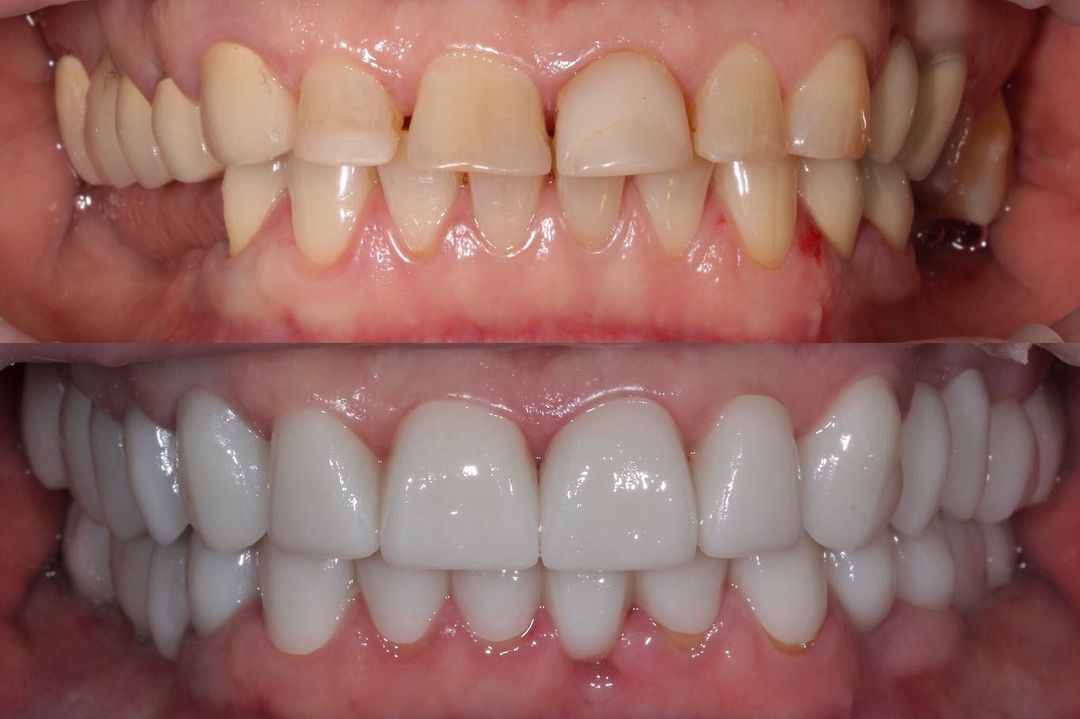 Имплантация зубов в У-Ка. Импланты