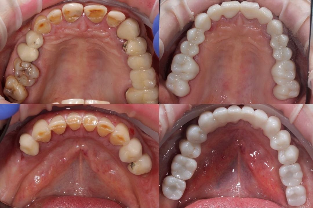 Имплантация зубов в У-Ка. Импланты